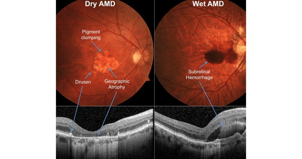 Age-Related Macular Degeneration: Poised For A New Treatment Era
