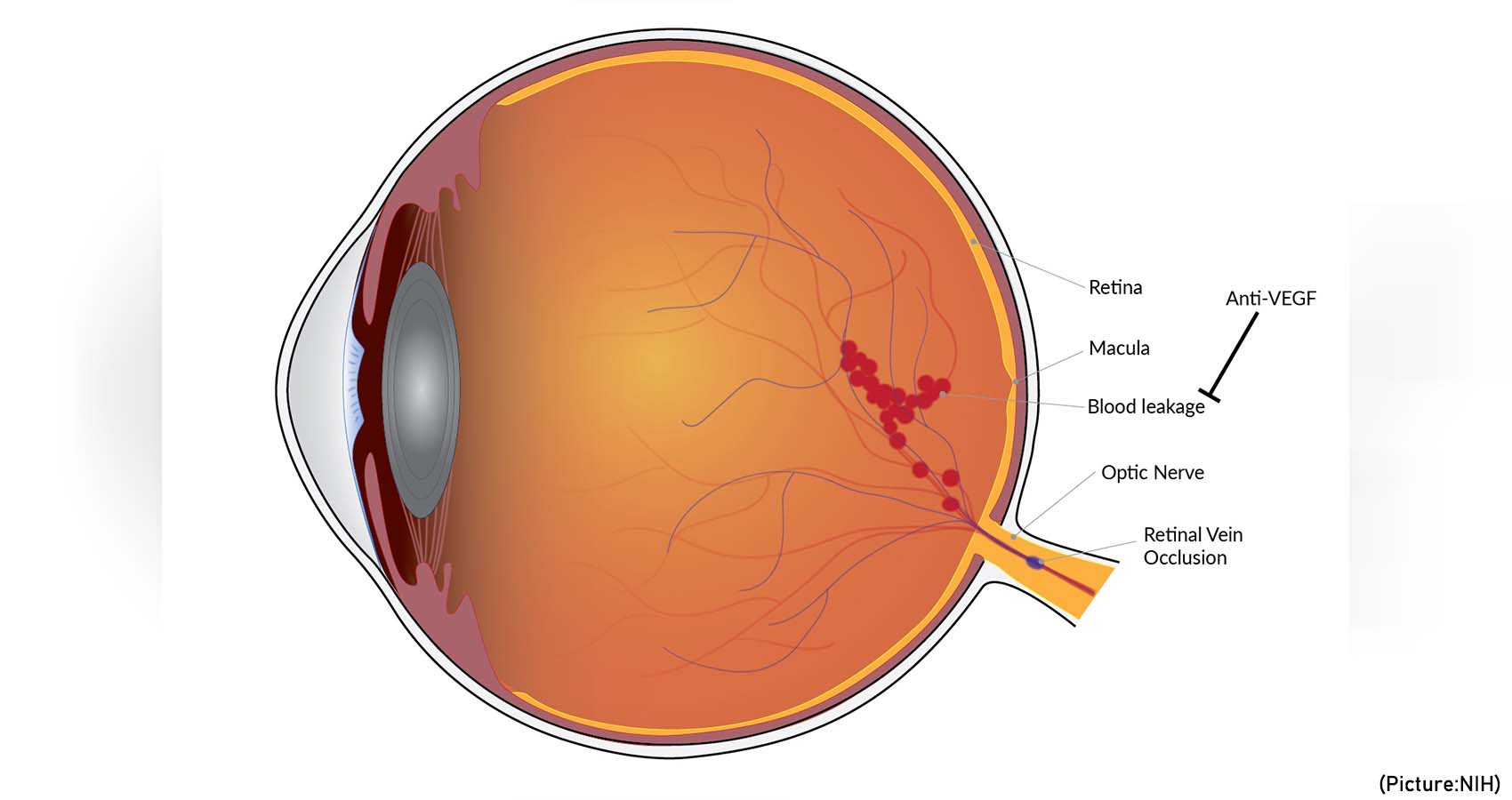 Vision Improvement Is Long-Lasting With Treatment For Blinding Blood Vessel Condition