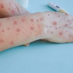 Feature and Cover WHO Declares Public Health Emergency as Deadly Mpox Outbreak Spreads in Africa