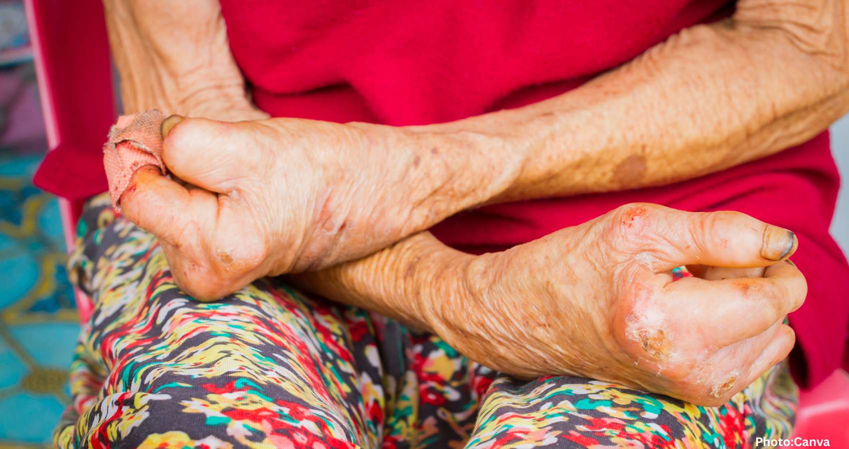 New Study Finds Leprosy in the Americas Predated European Arrival