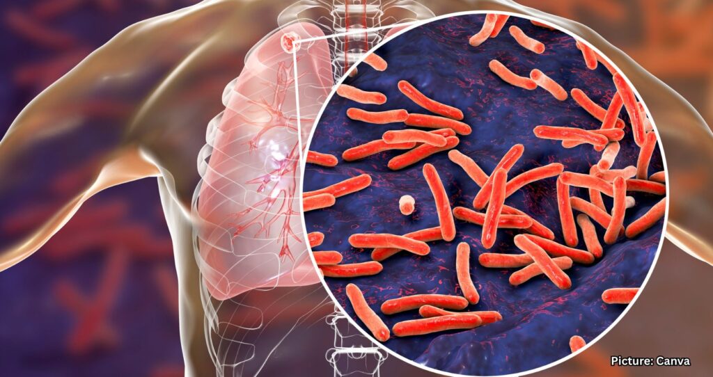 Three Active Tuberculosis Cases Reported in Maine Amid Rising National Trends