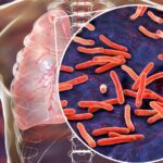 Featured & Cover Three Active Tuberculosis Cases Reported in Maine Amid Rising National Trends