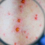 Feature and Cover Hidden Infection Claims Millions of Children's Lives Each Year