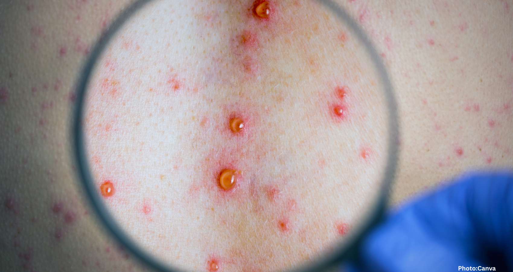 Feature and Cover Hidden Infection Claims Millions of Children's Lives Each Year