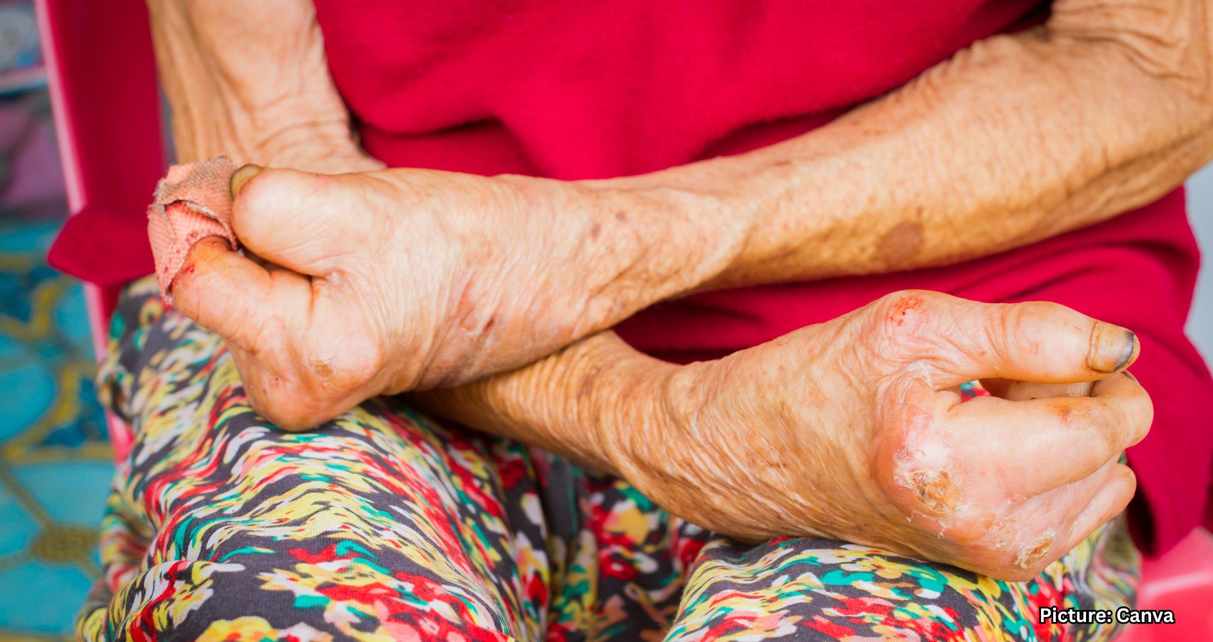 Featured & Cover New Study Finds Leprosy in the Americas Before European Arrival