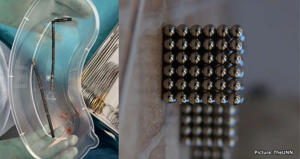 Featured & Cover Teen Hospitalized After Swallowing Up to 100 Magnets Purchased Online