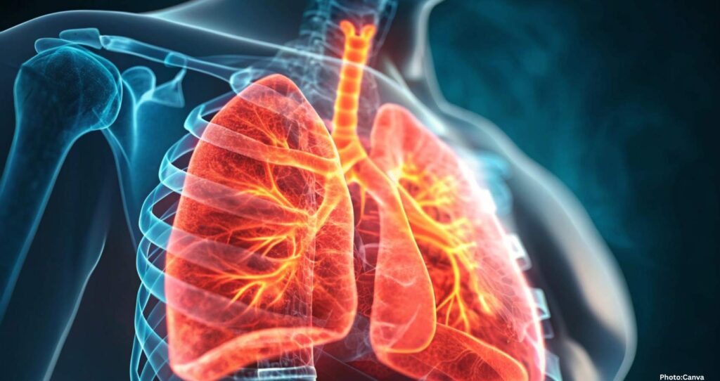 Deadly Cancer Often Overlooked by Patients Due to Lack of Screening