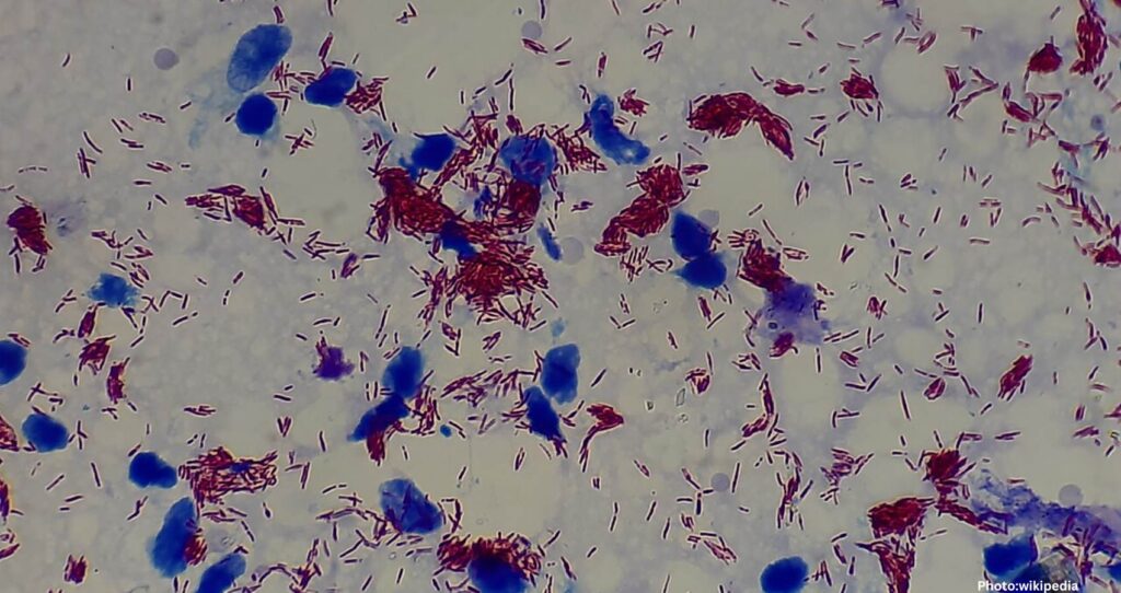 New Study Shows Leprosy Existed in the Americas Before European Arrival