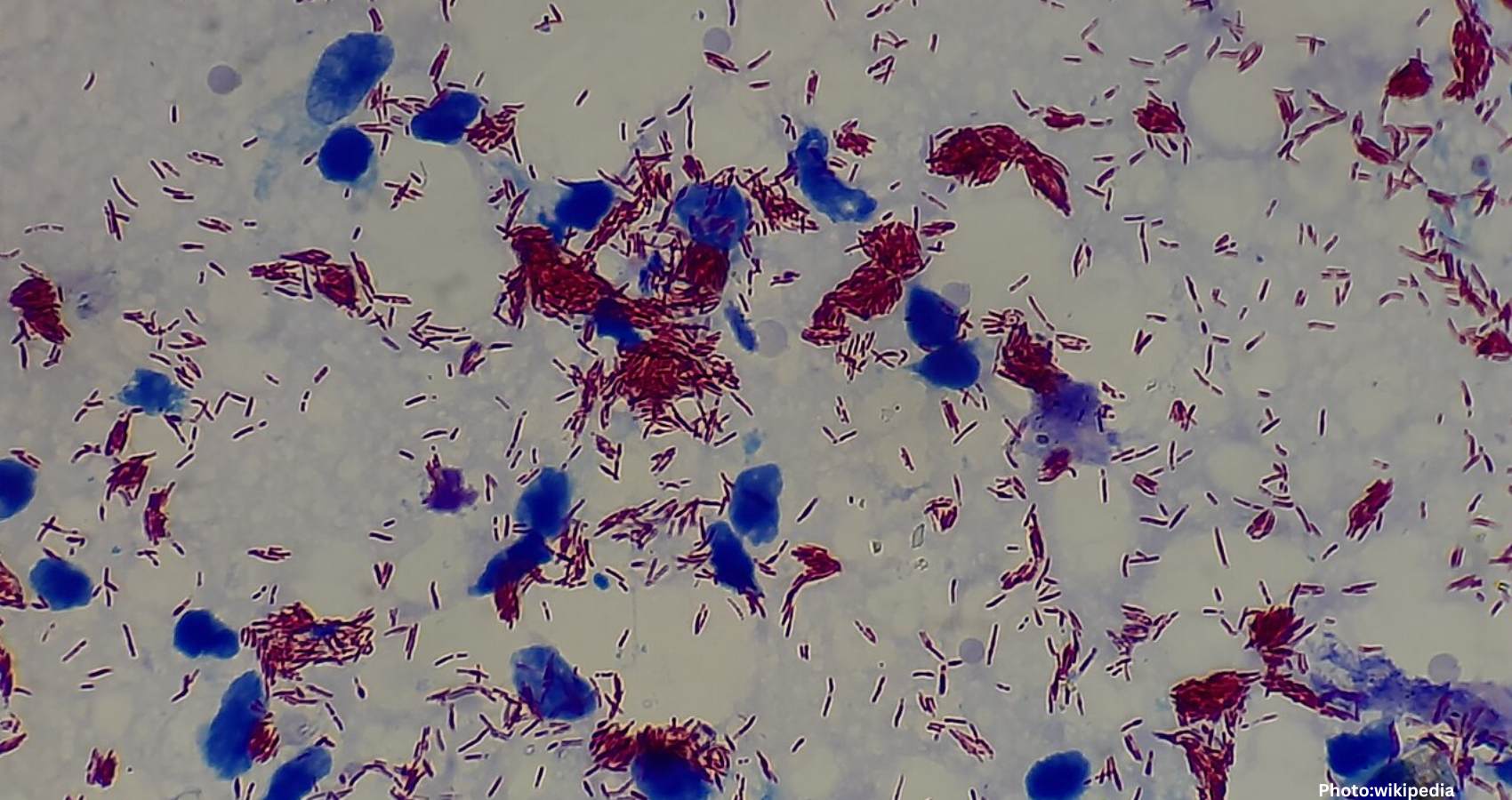 Feature and Cover New Study Shows Leprosy Existed in the Americas Before European Arrival