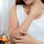 Featured & Cover Doctors Warn of Alarming Increase in Adult Onset Food Allergies