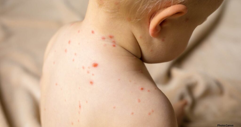 Major Measles Outbreak Results in Hundreds Quarantined in U.S. County
