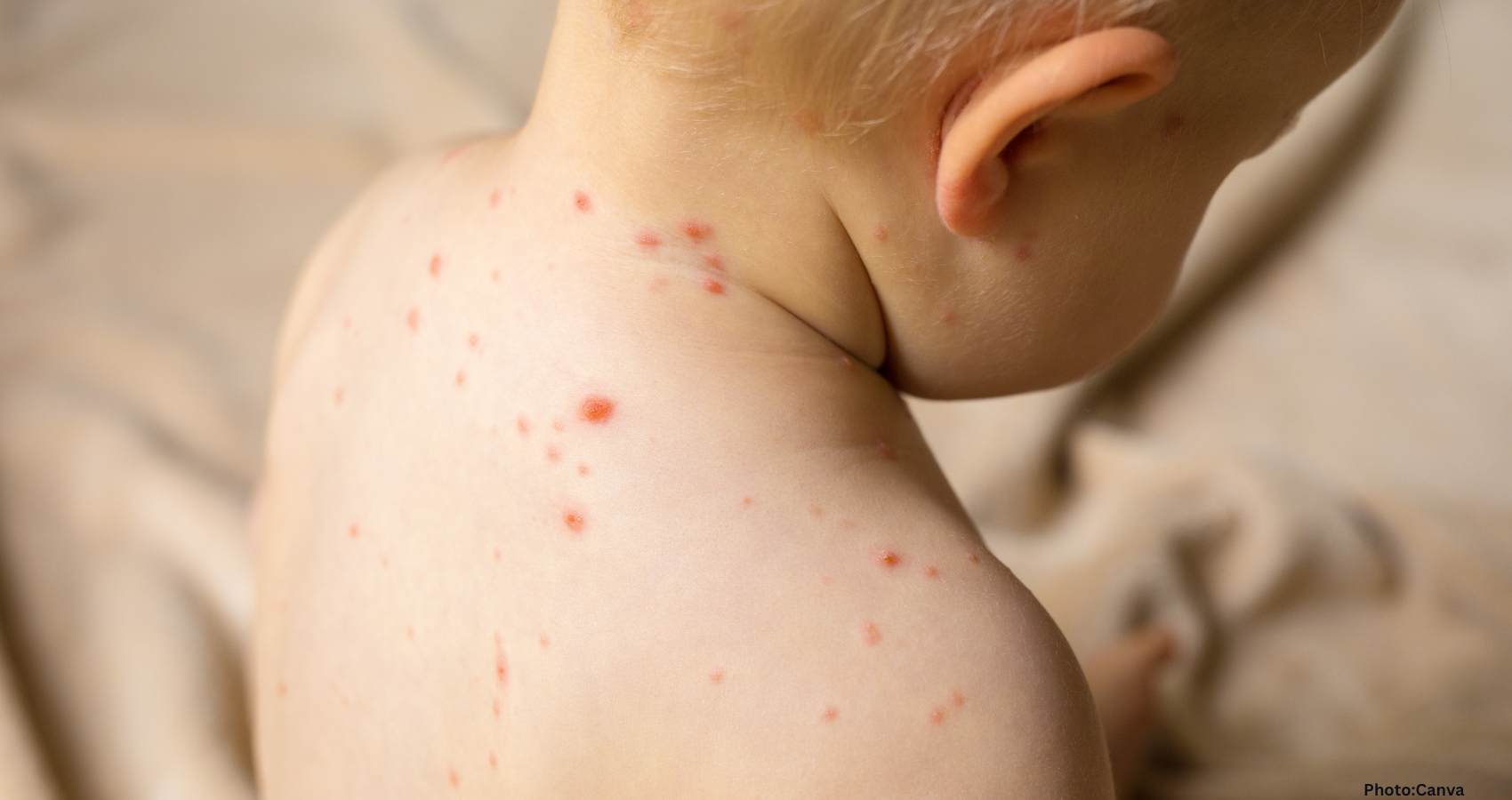 Feature and Cover Major Measles Outbreak Results in Hundreds Quarantined in U S County