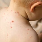 Feature and Cover Measles Cases Surpass 200 in South Carolina Multiple Hospitalizations Reported
