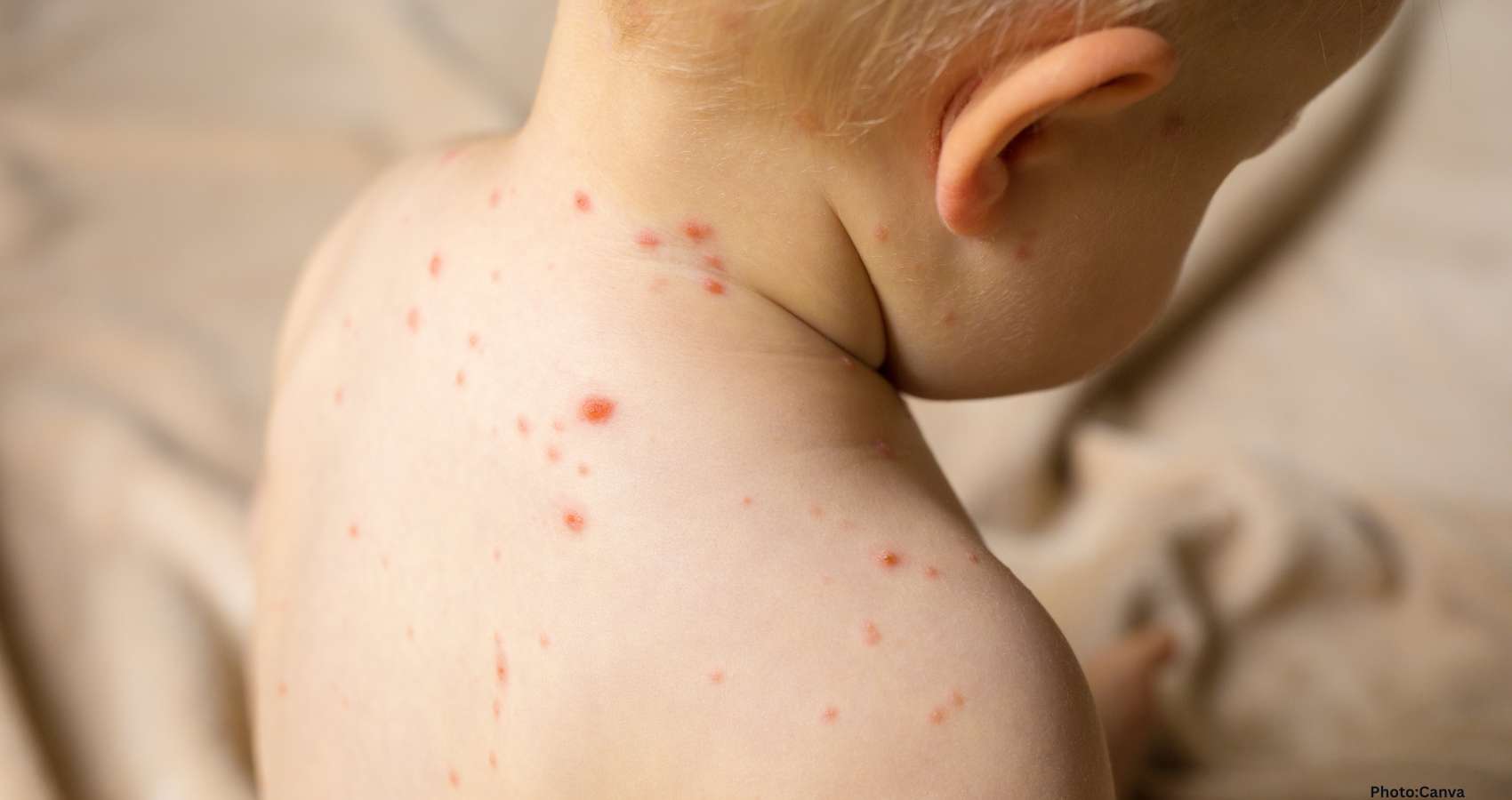 Measles Cases Surpass 200 in South Carolina, Multiple Hospitalizations Reported