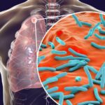 Feature and Cover Tuberculosis Outbreak Investigated at Prominent High School