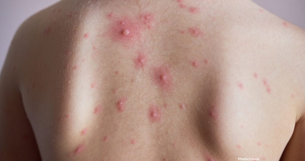 First Severe Mpox Case Reported in Major City, Described as Life-Threatening