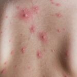 Featured & Cover First Severe Mpox Case Reported in Major City Described as Life Threatening