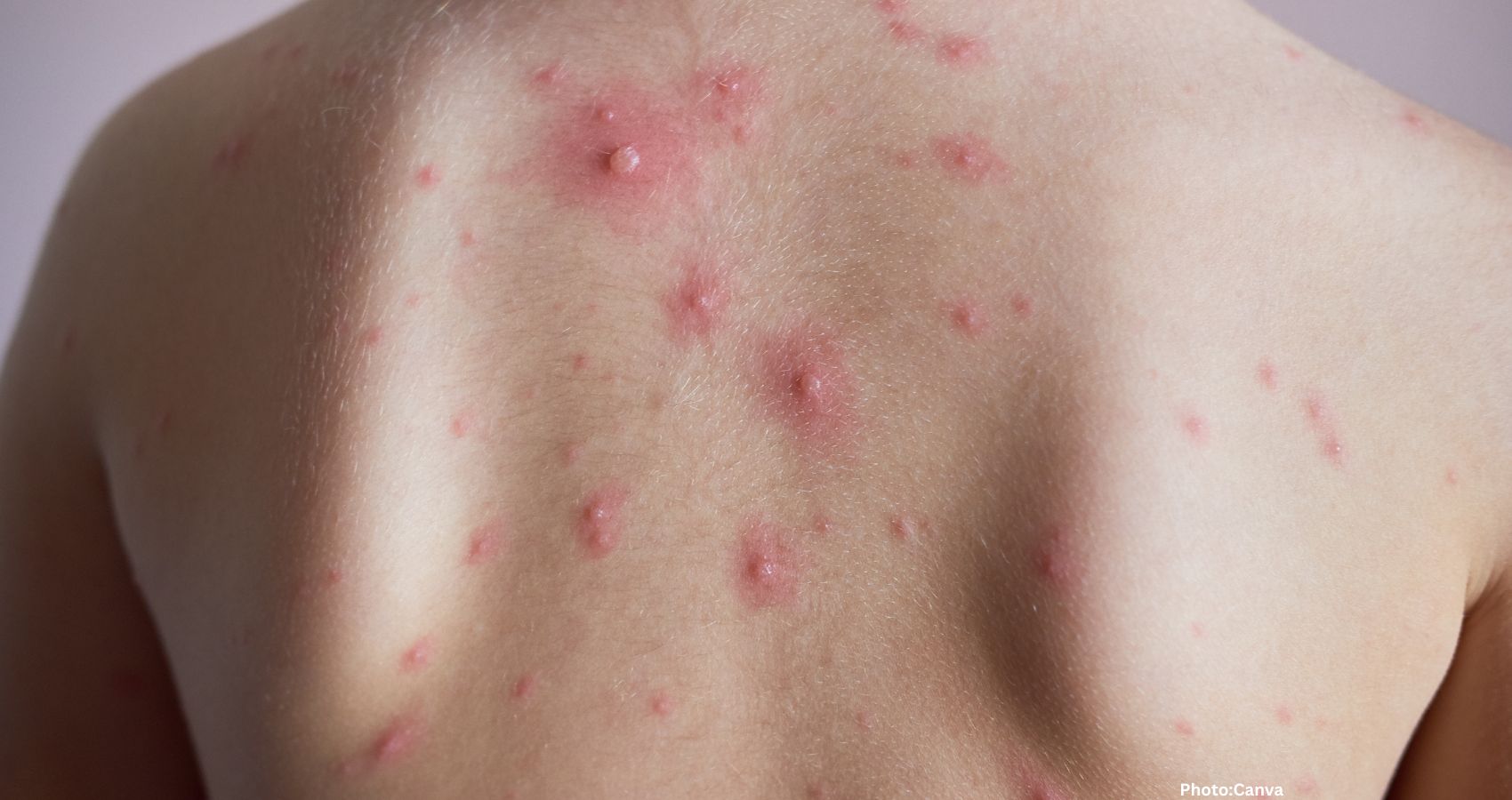 Featured & Cover First Severe Mpox Case Reported in Major City Described as Life Threatening