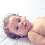 Featured & Cover At Least 46 Children Dead in Global Measles Outbrea