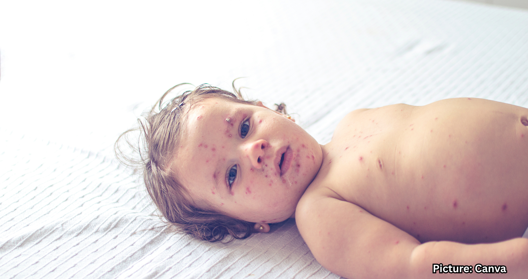 Featured & Cover At Least 46 Children Dead in Global Measles Outbrea