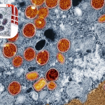 Featured & Cover First Clade I Mpox Case Confirmed in Connecticut After European Travel