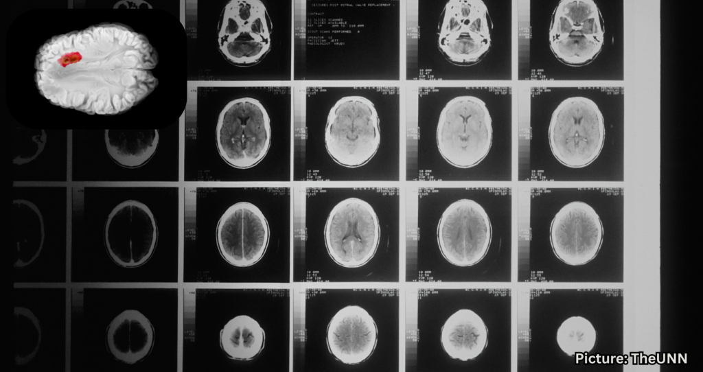 NIH Study Suggests Testosterone May Slow Aggressive Brain Tumors in Men