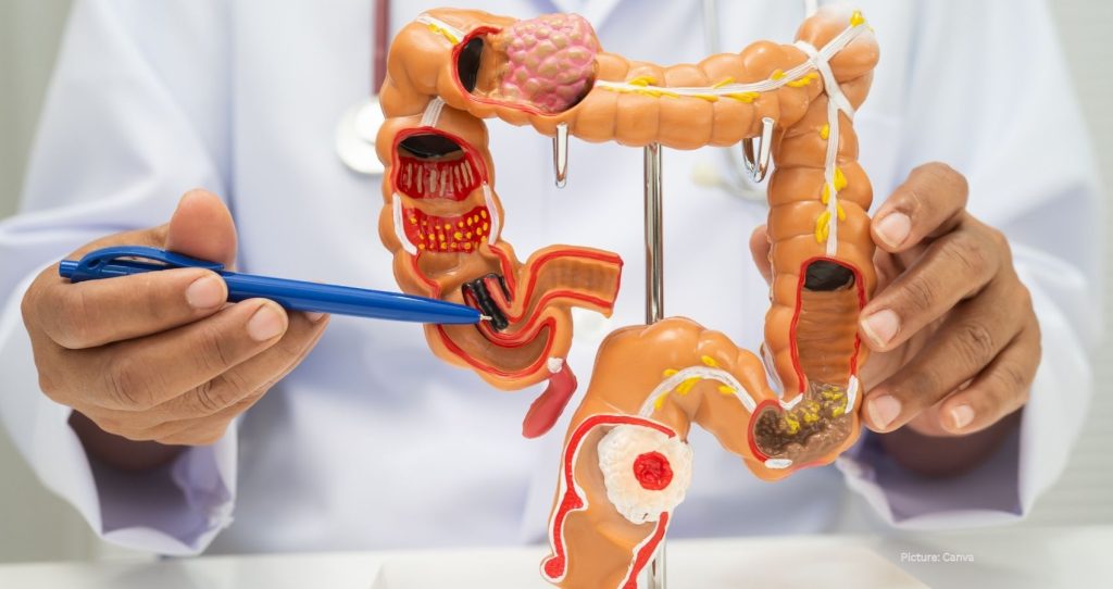 Doctors Advocate for New Blood Tests as Colon Cancer Cases Rise Among Younger Adults