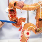 The UNN Cover Doctors Advocate for New Blood Tests as Colon Cancer Cases Rise Among Younger Adults
