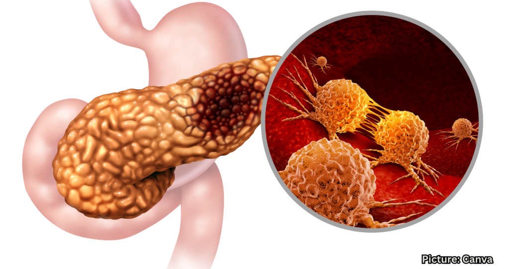 Breakthrough Drug for Pancreatic Cancer Surprises Experts with Survival Gains