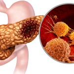 Featured & Cover Breakthrough Drug for Pancreatic Cancer Surprises Experts with Survival Gains