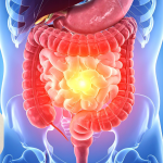 Featured & Cover Coping Strategies for Indian Americans Facing Colorectal Cancer