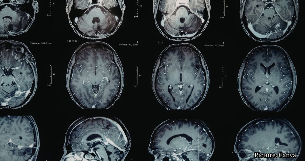 Brain Tumor Detected During Preventive Scan Highlights Full-Body MRIs