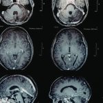 Featured & Cover Brain Tumor Detected During Preventive Scan Highlights Full Body MRIs
