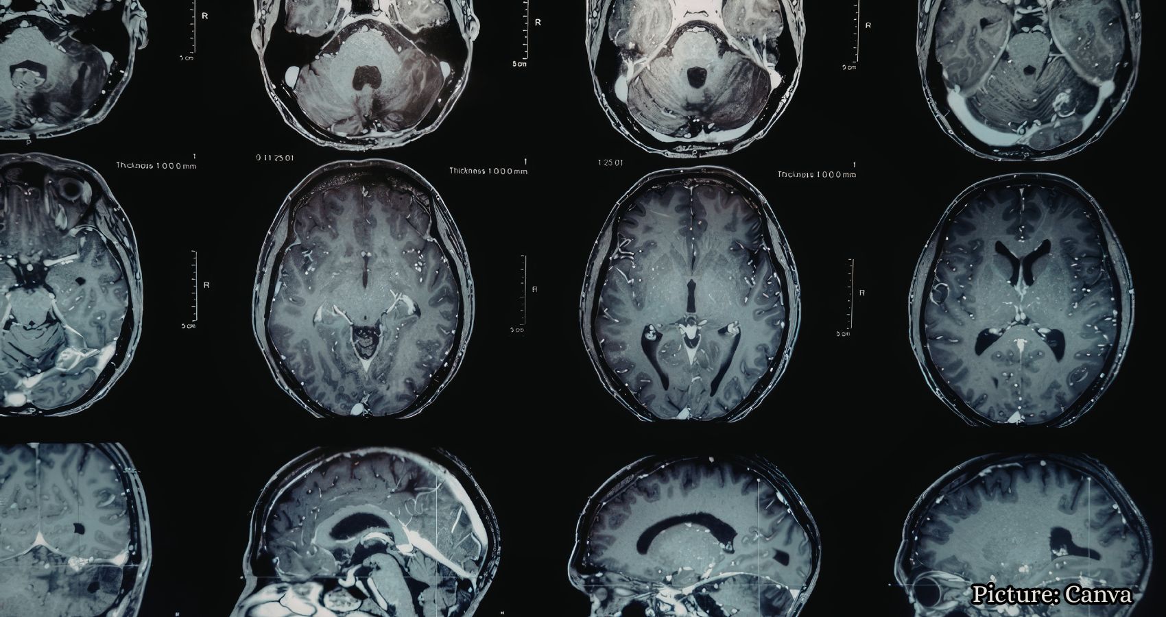 Featured & Cover Brain Tumor Detected During Preventive Scan Highlights Full Body MRIs