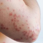 Featured & Cover Measles Resurgence in the U S Linked to Declining Vaccination Rates
