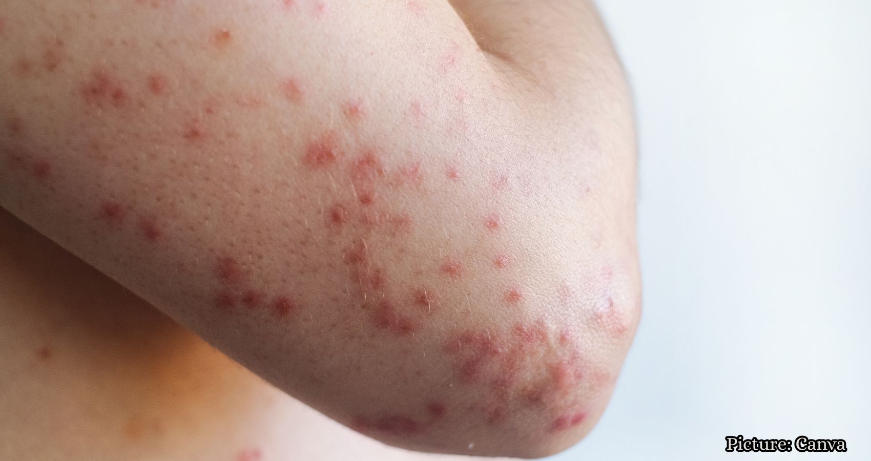 Featured & Cover Measles Resurgence in the U S Linked to Declining Vaccination Rates