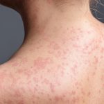Featured & Cover Deadly Measles Outbreak in Northeast Claims First Lives in 35 Years