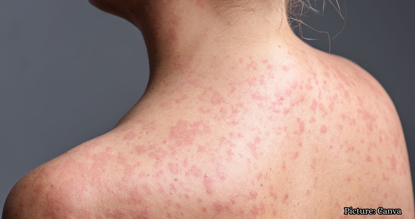 Featured & Cover Deadly Measles Outbreak in Northeast Claims First Lives in 35 Years